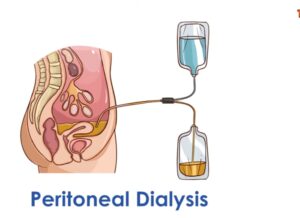 Peritoneal 