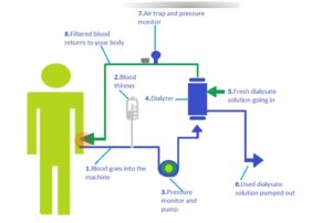 Dialysis 